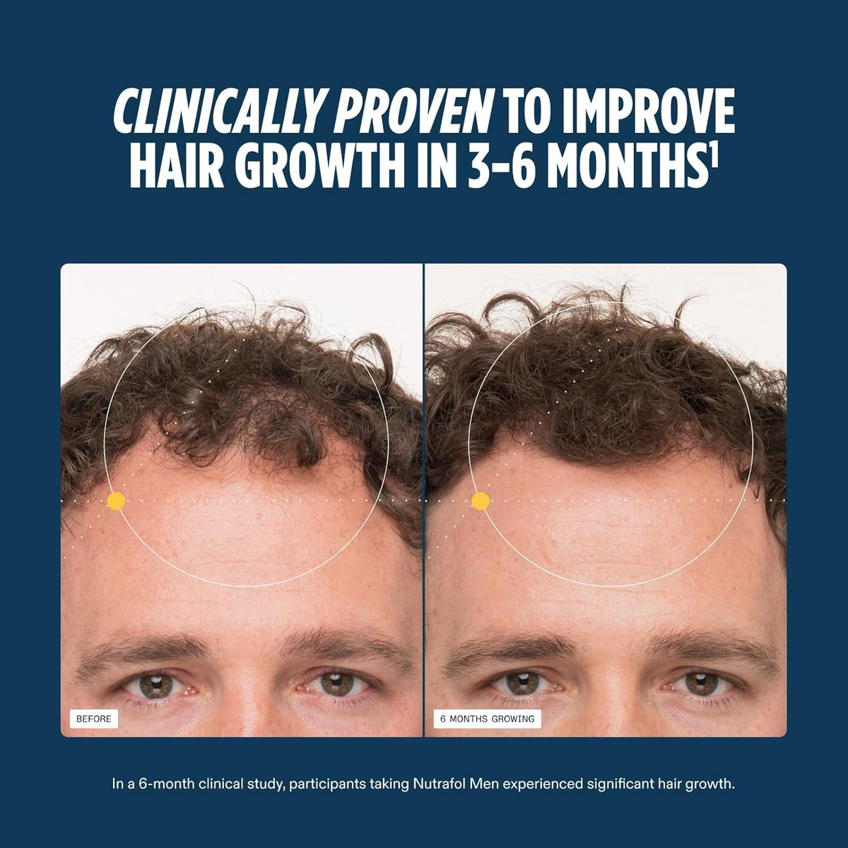 Nutrafol Men Hair Growth Supplements, Ages 18-49, 1-Month Bottle | #1 Dermatologist-Recommended Hair Growth Supplement Brand, Clinically Tested for Visibly Thicker Hair and Scalp Coverage